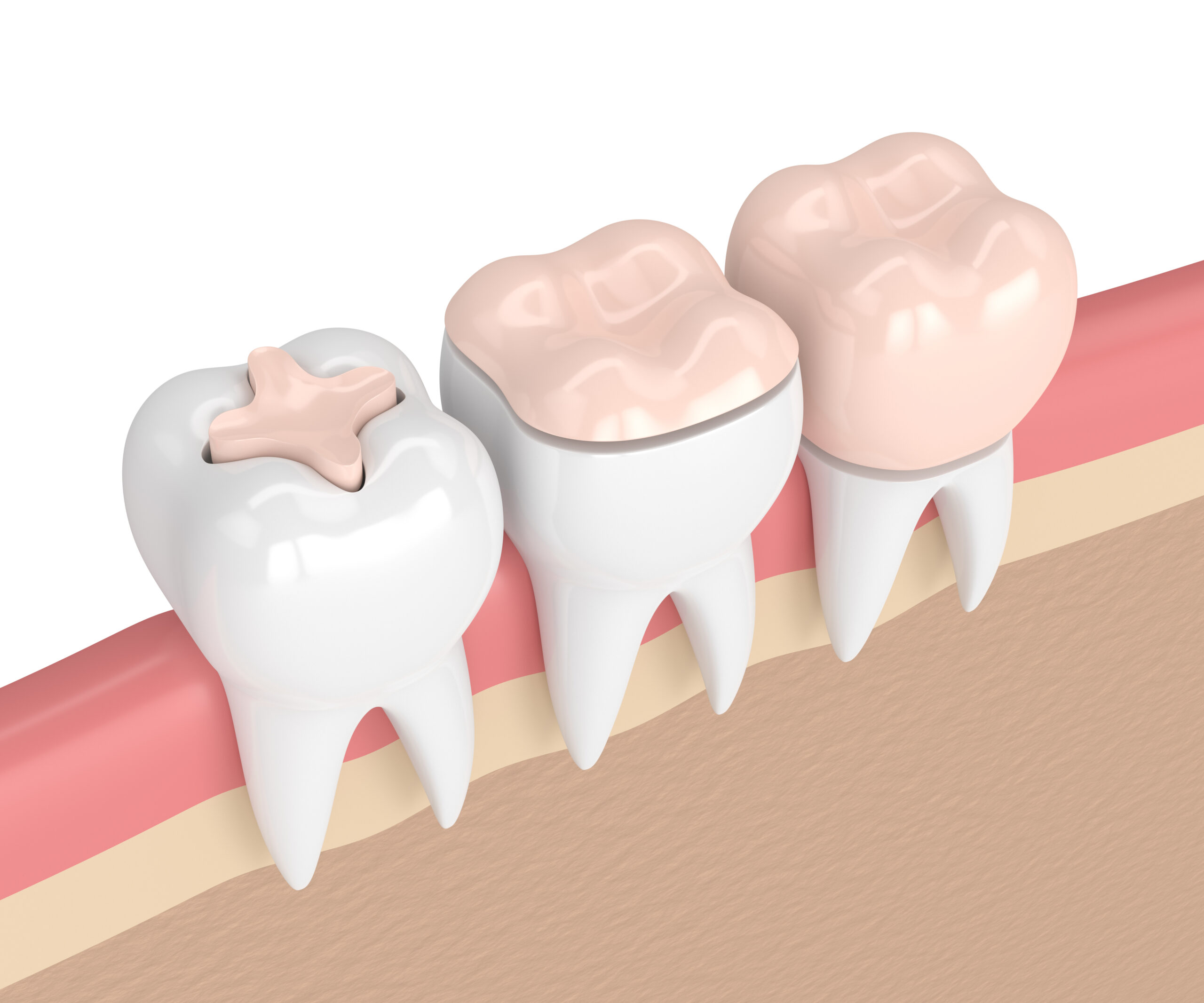 3d render of teeth with different types of dental filling