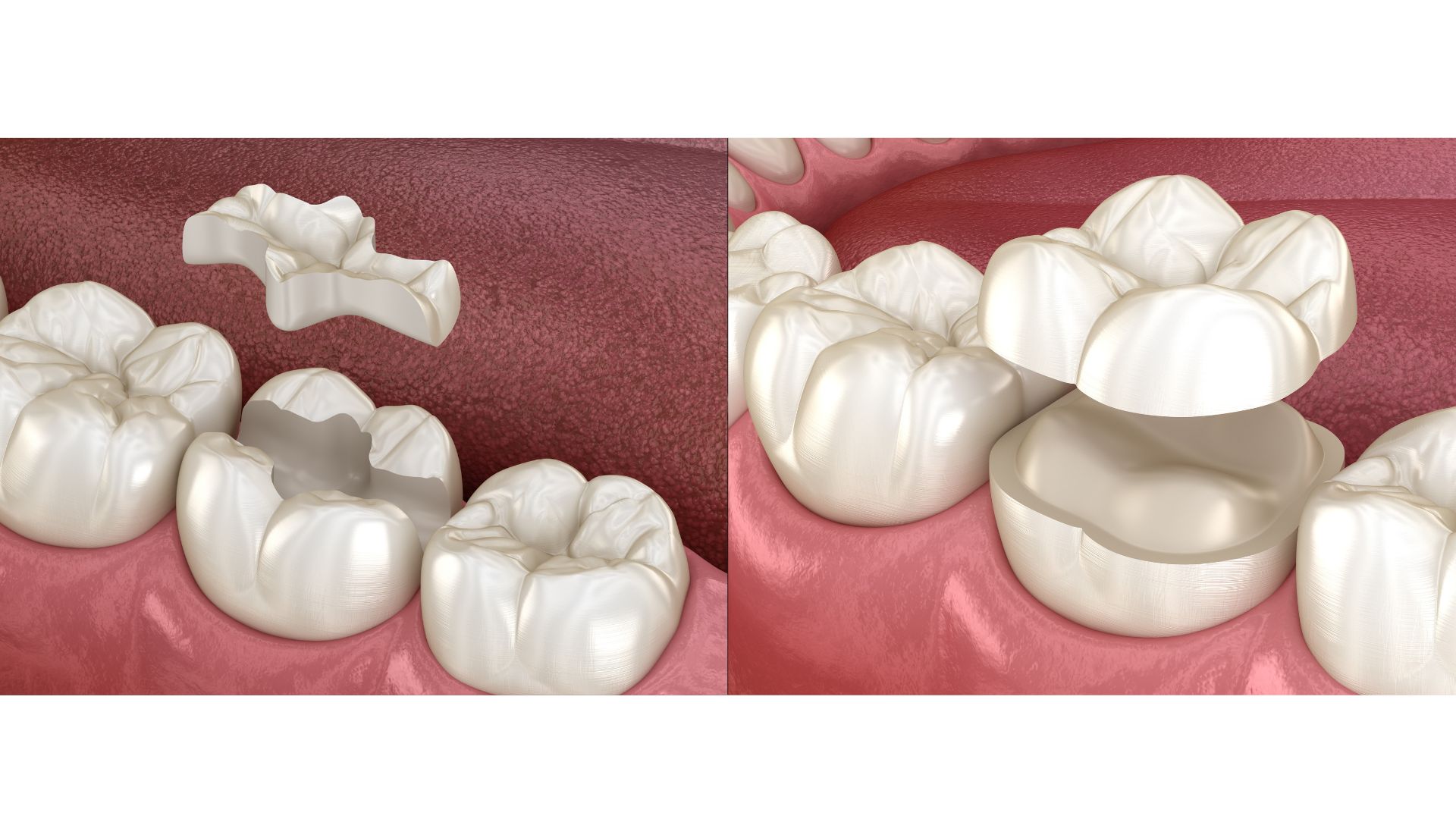 HEALTHY TOOTH